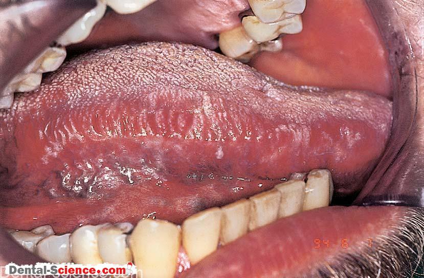 Hairy Tongue Leukoplakia 60