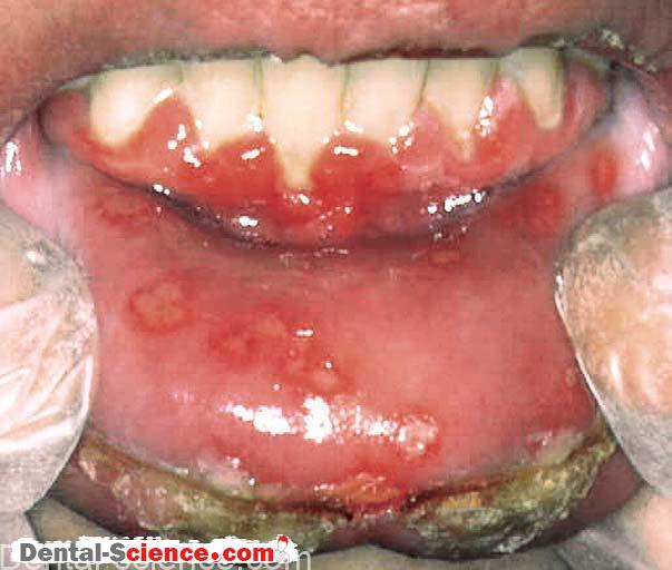 Primary Herpetic Stomatitis | Herpes Simplex | Infection