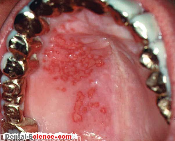 Genital Herpes Symptoms | STD Test Express
