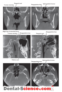pterygopalatine fossa radiology