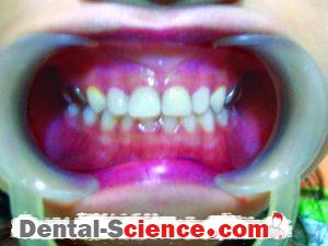 Anterior teeth – After treatment