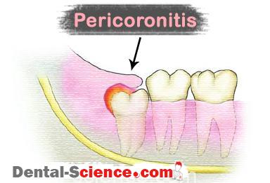 Pain of wisdom teeth due to pericoronitis