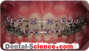 metalic braces