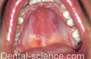 Erythematous candidosis of the palate.