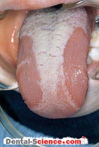Geographic tongue.