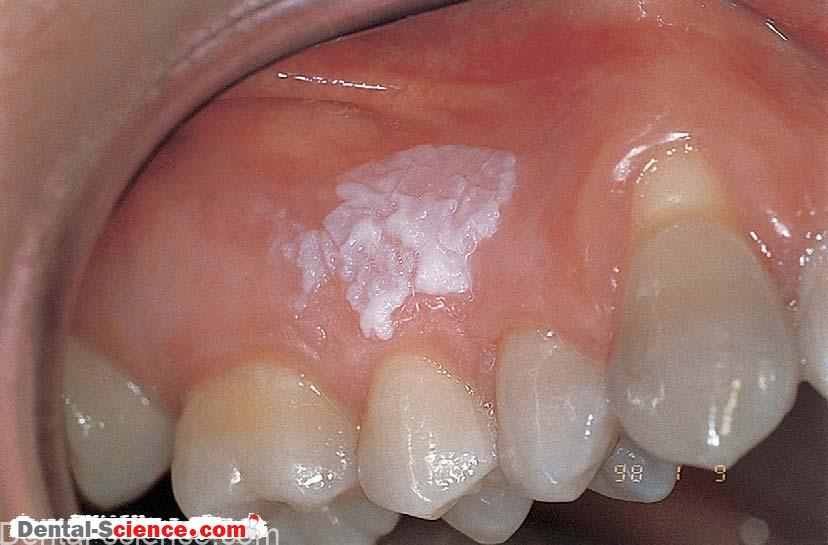 Leukoplakia - Dental Science