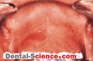 Oral erythroplakia 