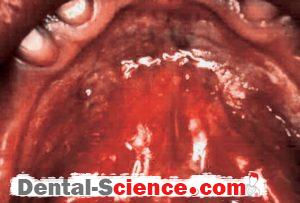 Oral erythroplakia 