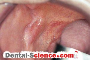 Salivary gland neoplasms