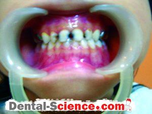 Anterior teeth – Before treatment