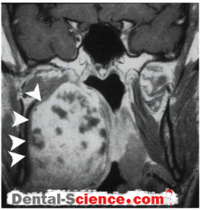 Benign Minor Salivary Gland Tumors (Pleo morphic Adenomal Monomorphic Adenomal Warthin/s Tumor)