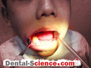 Suction tip is best rested on occlusal surfaces of teeth of opposite side