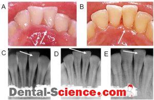 acute periodontitis