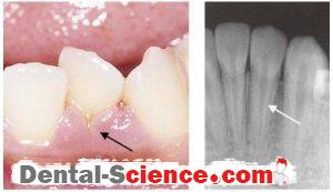 periodontitis associated with radicular-gingival groove