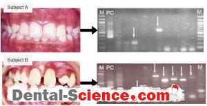 Detection of periodontal bacterial species in oral specimens by PCR methods.