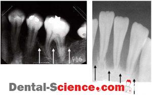 localized juvenile periodontitis