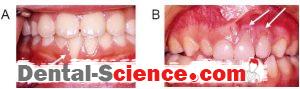 gingival recession 