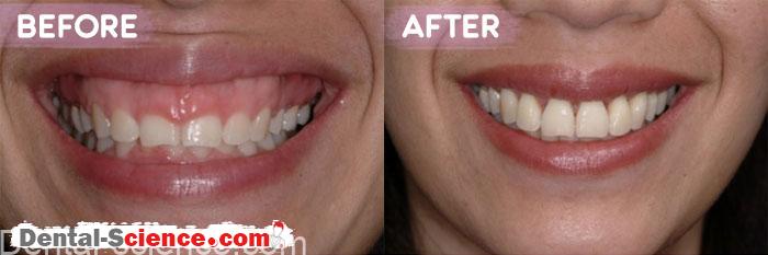 Gummy-Smile-Before-and-after-treatment