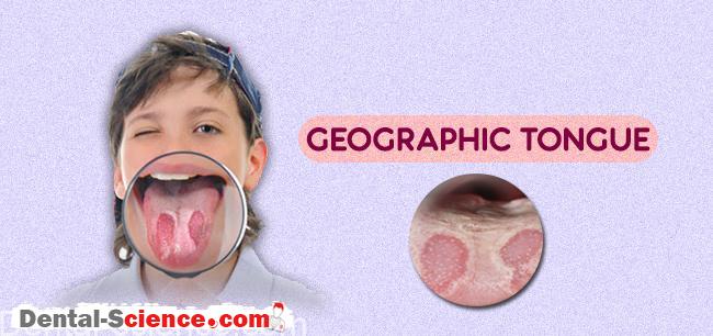 Geographic tongue appearance