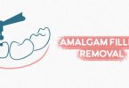 Amalgam Filling removal