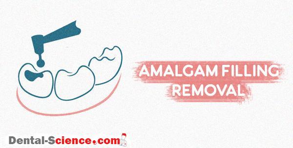 Amalgam removal