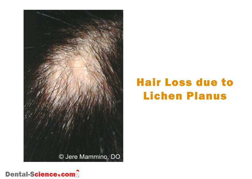 Permanent hair loss may occur 