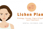 Lichen Planus Treatment, Causes, Signs and symptoms