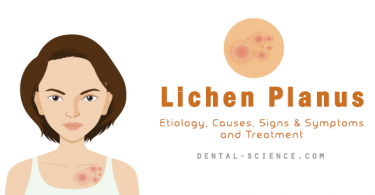 Lichen Planus Treatment, Causes, Signs and symptoms