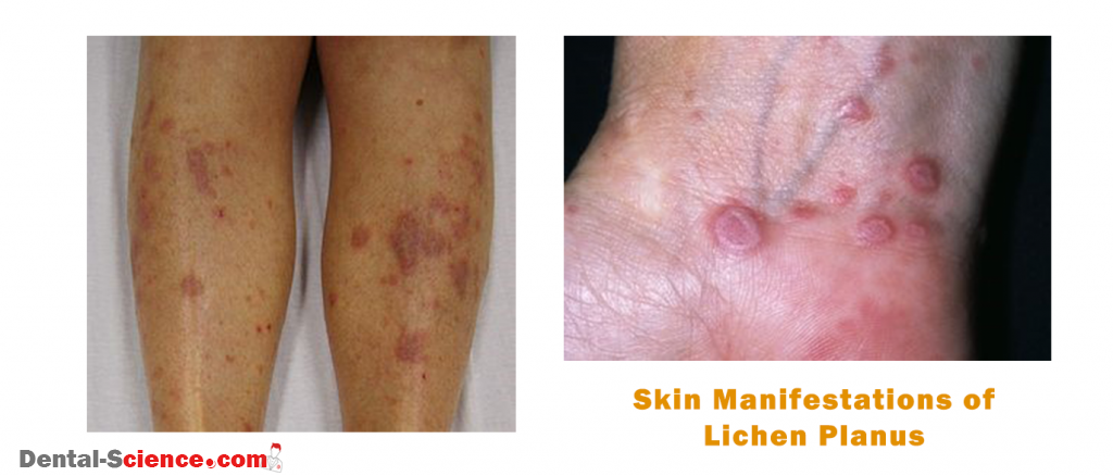 Skin Manifestations - Flexor and legs - papular 